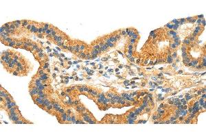 Immunohistochemistry of paraffin-embedded Human thyroid cancer tissue using RRAGA Polyclonal Antibody at dilution 1:30 (RRAGA Antikörper)