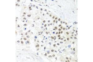 Immunohistochemistry of paraffin-embedded human lung cancer using TRMT1 antibody at dilution of 1:100 (x40 lens). (TRMT1 Antikörper)