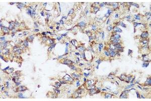 Immunohistochemistry of paraffin-embedded Human lung cancer using ERK1 / ERK2 Polyclonal Antibody at dilution of 1:200 (40x lens). (ERK1/2 Antikörper)