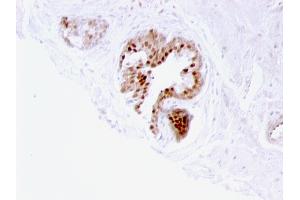 Formalin-fixed, paraffin-embedded human Prostate Carcinoma stained with p57 Mouse Monoclonal Antibody (57P06). (CDKN1C Antikörper)