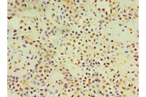 Immunohistochemistry of paraffin-embedded human breast cancer using ABIN7149492 at dilution of 1:100 (DACT3 Antikörper  (AA 1-160))