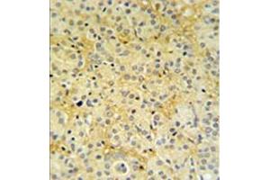 Formalin fixed, paraffin embedded prostate carcinoma stained with DAZAP2 Antibody (C-term) followed by peroxidase conjugation of the secondary antibody and DAB staining. (DAZAP2 Antikörper  (C-Term))