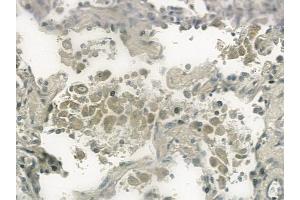 ABIN6259199 and ABIN6274305 at 1/100 staining human lung squamous cell carcinoma by IHC-P.