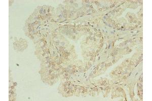 Immunohistochemistry of paraffin-embedded human prostate cancer using ABIN7155120 at dilution of 1:100 (HNRNPL Antikörper  (AA 89-335))