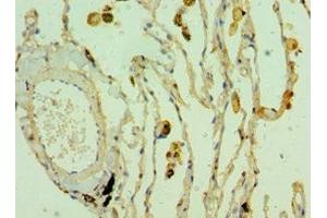 Immunohistochemistry of paraffin-embedded human lung cancer using ABIN7171841 at dilution of 1:100 (CLEC3B Antikörper  (AA 22-202))