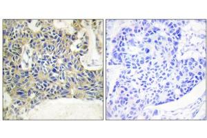 Immunohistochemistry analysis of paraffin-embedded human breast carcinoma tissue using PKC theta (Phospho-Ser695) antibody. (PKC theta Antikörper  (pSer695))