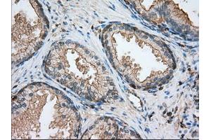 Immunohistochemical staining of paraffin-embedded Adenocarcinoma of ovary tissue using anti-ALDH3A1 mouse monoclonal antibody. (ALDH3A1 Antikörper)