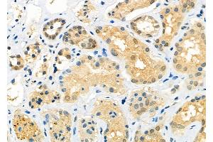ABIN6260357 and ABIN6273203 at 1/100 staining Human kidney cancer and adjacent normal tissues by IHC-P.