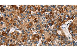 Immunohistochemistry of paraffin-embedded Human liver cancer tissue using SLAMF8 Polyclonal Antibody at dilution 1:40 (SLAMF8 Antikörper)