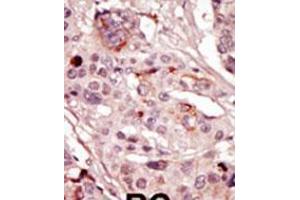 Formalin-fixed and paraffin-embedded human cancer tissue reacted with the primary antibody, which was peroxidase-conjugated to the secondary antibody, followed by AEC staining. (SRMS Antikörper  (N-Term))