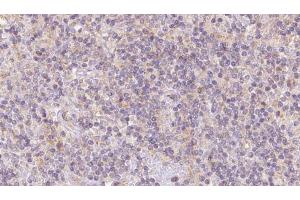 ABIN6273103 at 1/100 staining Human lymph cancer tissue by IHC-P. (Coq7 Antikörper  (Internal Region))