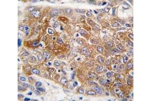 IHC analysis of FFPE human hepatocarcinoma tissue stained with ALDH1L1 antibody