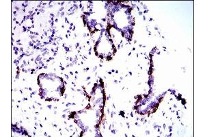 Immunohistochemical analysis of paraffin-embedded prostate tissues using CK5 mouse mAb with DAB staining. (Cytokeratin 5 Antikörper  (AA 316-590))