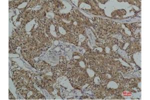 Immunohistochemistry (IHC) analysis of paraffin-embedded Human Breast Carcicnoma using HSC70 Mouse Monoclonal Antibody diluted at 1:200. (Hsc70 Antikörper)