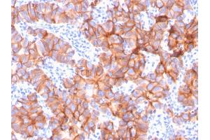Formalin-fixed, paraffin-embedded human Breast Carcinoma stained with HER-2 Mouse Monoclonal Antibody (ERBB2/3079). (ErbB2/Her2 Antikörper  (AA 311-462))