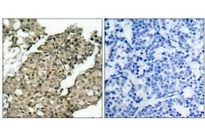Immunohistochemical analysis of paraffin-embedded human breast carcinoma tissue using G3BP-1 (phospho-Ser232) antibody (E021102). (G3BP1 Antikörper  (pSer232))