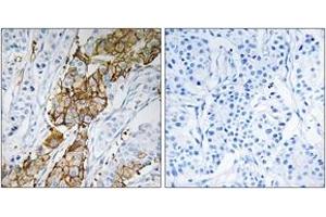 Immunohistochemistry analysis of paraffin-embedded human breast carcinoma tissue, using USP32 Antibody. (USP32 Antikörper  (AA 271-320))