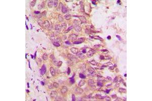 Immunohistochemical analysis of BAD staining in human prostate cancer formalin fixed paraffin embedded tissue section. (BAD Antikörper  (C-Term))