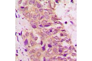 Immunohistochemical analysis of BAD staining in human prostate cancer formalin fixed paraffin embedded tissue section.