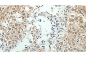 Immunohistochemistry of paraffin-embedded Human lung cancer using NDRG2 Polyclonal Antibody at dilution of 1:50 (NDRG2 Antikörper)