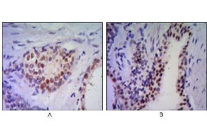 Immunohistochemical analysis of paraffin-embedded human prostata tissues (A, B) using anti-NKX3A antibody with DAB staining. (NKX3-1 Antikörper)