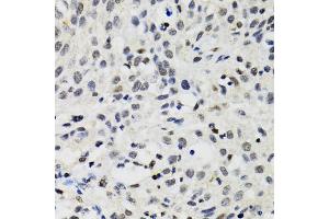 Immunohistochemistry of paraffin-embedded human lung cancer using SMARCAD1 antibody (ABIN2560015) at dilution of 1:100 (40x lens). (SMARCAD1 Antikörper)