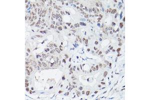 Immunohistochemistry of paraffin-embedded human colon carcinoma using DNA Ligase IV Rabbit pAb (ABIN3022474, ABIN3022475, ABIN3022476 and ABIN6218843) at dilution of 1:100 (40x lens). (LIG4 Antikörper  (AA 612-911))