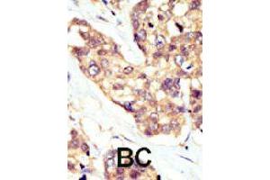 Formalin-fixed and paraffin-embedded human cancer tissue reacted with DOK5 polyclonal antibody  , which was peroxidase-conjugated to the secondary antibody, followed by AEC staining. (DOK5 Antikörper  (AA 276-306))