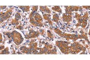 Immunohistochemistry of paraffin-embedded Human breast cancer tissue using COL20A1 Polyclonal Antibody at dilution 1:40 (COL20A1 Antikörper)