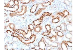 Formalin-fixed, paraffin-embedded human Renal Cell Carcinoma stained with KSP-Cadherin Rabbit Recombinant Monoclonal Antibody (CDH16/1532R) (Rekombinanter Cadherin-16 Antikörper)