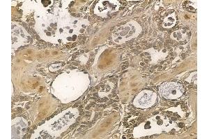 NSMAF Mouse Monoclonal Antibody at 1/100 staining human ovarian cancer by IHC-P. (NSMAF Antikörper)