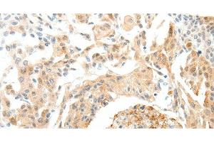 Immunohistochemistry of paraffin-embedded Human cervical cancer tissue using SEMA3D Polyclonal Antibody at dilution 1:50 (SEMA3D Antikörper)
