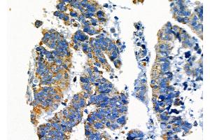 ABIN6265255 and ABIN6277135 at 1/100 staining Human colorectal cancer by IHC-P. (SPDYA Antikörper  (Internal Region))