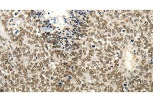 Immunohistochemistry of paraffin-embedded Human ovarian cancer tissue using Frizzled 10 Polyclonal Antibody at dilution 1:50 (FZD10 Antikörper)