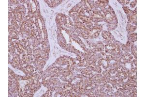 IHC-P Image Immunohistochemical analysis of paraffin-embedded human breast cancer, using HXK I, antibody at 1:250 dilution. (Hexokinase 1 Antikörper)