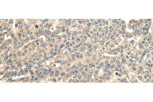 Immunohistochemistry of paraffin-embedded Human liver cancer tissue using CCDC113 Polyclonal Antibody at dilution of 1:65(x200) (CCDC113 Antikörper)