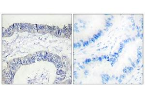 Immunohistochemistry analysis of paraffin-embedded human lung carcinoma tissue, using FA12 (heavy chain, Cleaved-Ile20) antibody. (F12 Antikörper  (Cleaved-Ile20, Heavy Chain, N-Term))