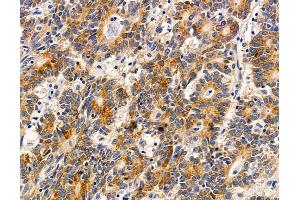 ABIN7095898 and ABIN7099960 at 1/100 staining human colorectal cancer and adjacent non-tumor tissue by IHC-P. (TRIML2 Antikörper)