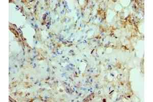 Immunohistochemistry of paraffin-embedded human prostate cancer using ABIN7150291 at dilution of 1:100 (RAD51D Antikörper  (AA 1-328))
