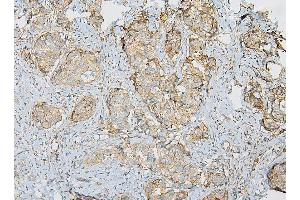 IHC analysis of IQGAP1 using anti-IQGAP1 antibody (ABIN6719262).