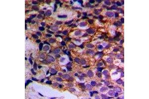 Immunohistochemical analysis of MTIF3 staining in human prostate cancer formalin fixed paraffin embedded tissue section. (MTIF3 Antikörper)