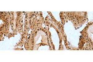 Immunohistochemistry of paraffin-embedded Human thyroid cancer tissue using BCL7B Polyclonal Antibody at dilution of 1:85(x200) (BCL7B Antikörper)