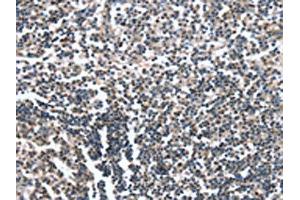The image on the left is immunohistochemistry of paraffin-embedded Human tonsil tissue using ABIN7190052(CAMTA1 Antibody) at dilution 1/15, on the right is treated with synthetic peptide. (CAMTA1 Antikörper)