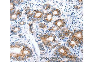 Immunohistochemistry of Human stomach cancer using CLDN7 Polyclonal Antibody at dilution of 1:50 (Claudin 7 Antikörper)
