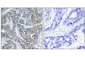 Immunohistochemical analysis of paraffin-embedded human breast carcinoma tissue, using Stathmin 1 (Ab-15) antibody (E021227). (Stathmin 1 Antikörper)