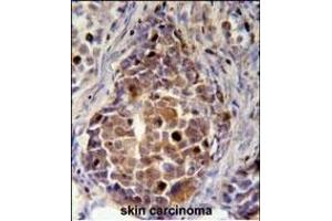 RDH16 Antibody (N-term (ABIN651647 and ABIN2840343) immunohistochemistry analysis in formalin fixed and paraffin embedded human skin carcinoma followed by peroxidase conjugation of the secondary antibody and DAB staining. (RDH16 Antikörper  (N-Term))