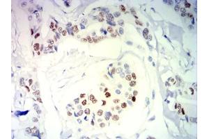 Immunohistochemical analysis of paraffin-embedded breast cancer tissues using PGR mouse mAb with DAB staining. (Progesterone Receptor Antikörper  (AA 166-411))
