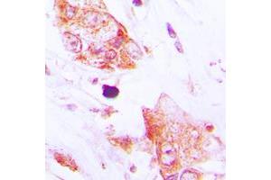 Immunohistochemical analysis of CDC42EP2 staining in human lung cancer formalin fixed paraffin embedded tissue section. (CDC42EP2 Antikörper  (N-Term))