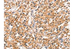 The image on the left is immunohistochemistry of paraffin-embedded Human thyroid cancer tissue using ABIN7192186(RHOBTB2 Antibody) at dilution 1/30, on the right is treated with synthetic peptide. (RHOBTB2 Antikörper)