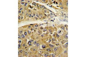 Formalin-fixed and paraffin-embedded human hepatocarcinoma reacted with SERPINA7 Antibody (C-term), which was peroxidase-conjugated to the secondary antibody, followed by DAB staining. (SERPINA7 Antikörper  (C-Term))